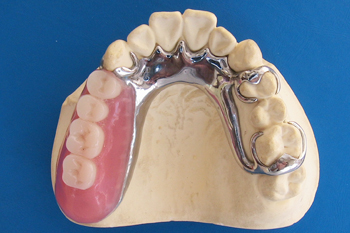 金属を使用する保険の入れ歯